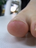 ヒールを履いての巻き爪でお悩みの方も当接骨院で完治　Y.T様　女性