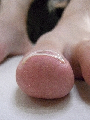 巻き爪症例　Y.O様