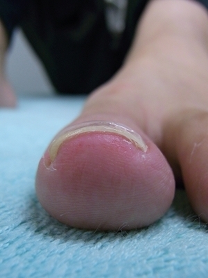 巻き爪症例　Y.O様