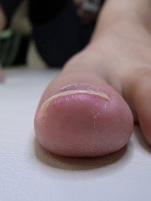 巻き爪症例　Y.O様
